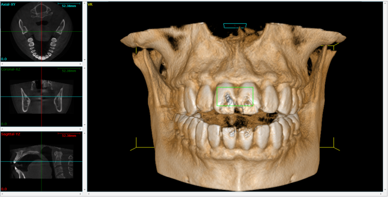 What Is CBCT / 3D Dental Imaging?
