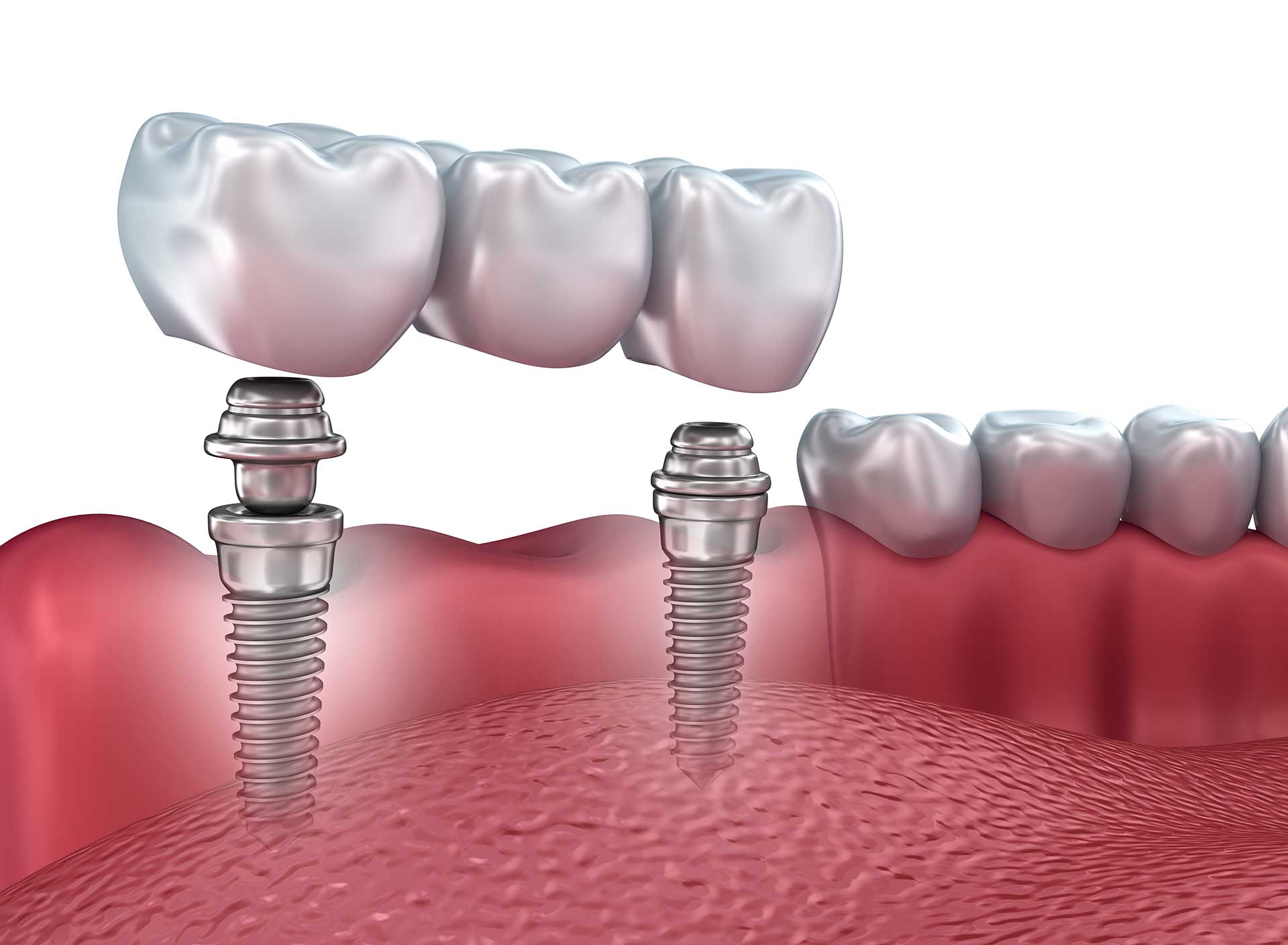 Dental Implants in  Cookeville, TN