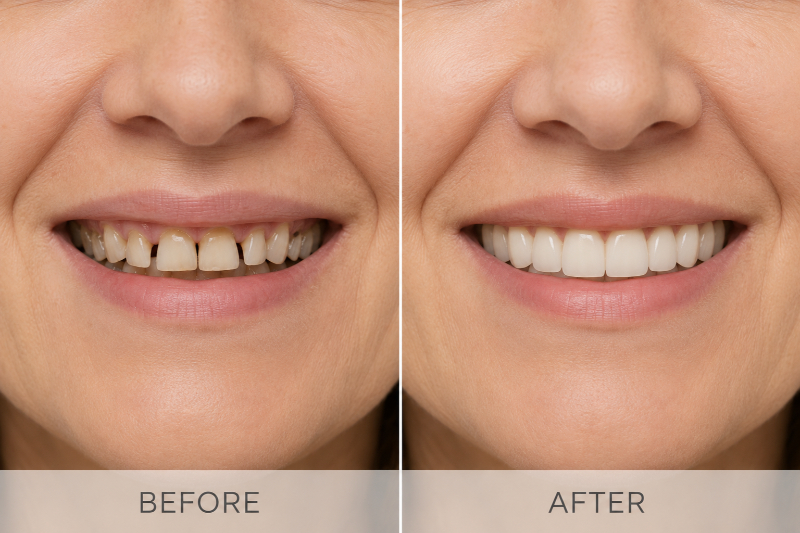 Who Needs Full Mouth Reconstruction?